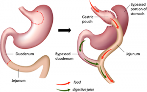 gastric-bypass